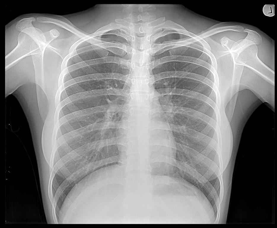 Radiology of chest