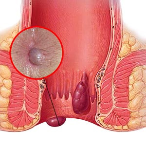 Anorectal Diseases for GPs