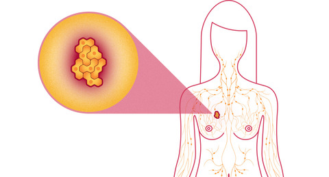 Breast and cervical cancers for GPs