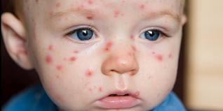 Common infections in children