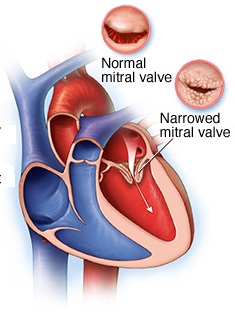 Valvular Heart Diseases for GPs